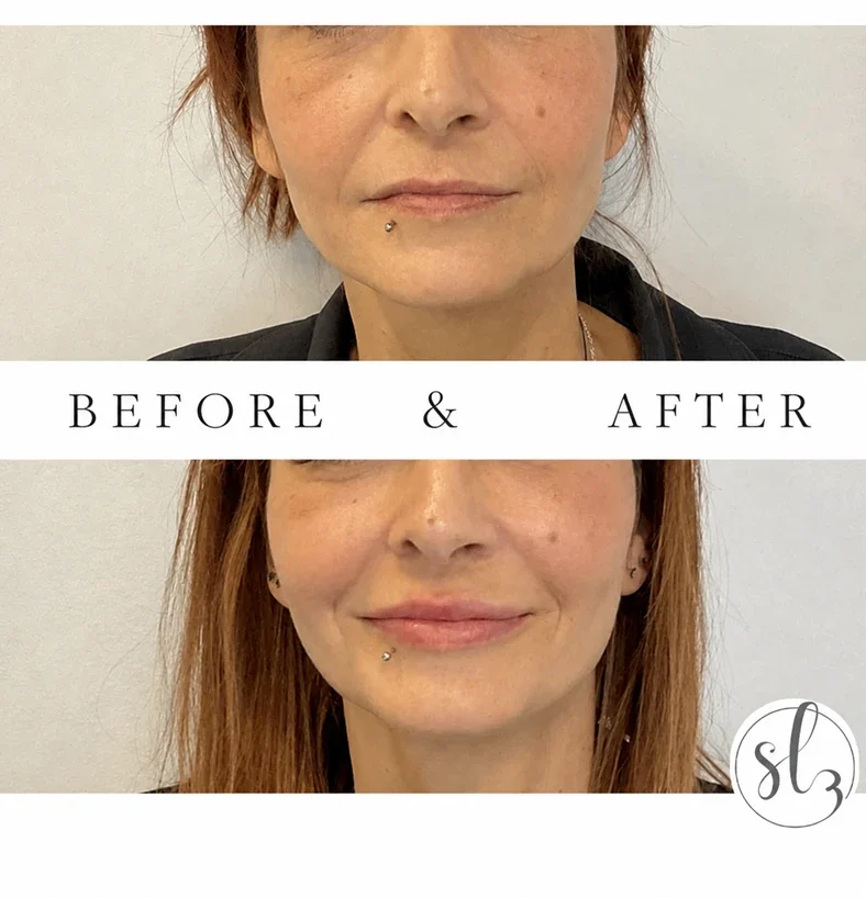 img-before-after-dermal